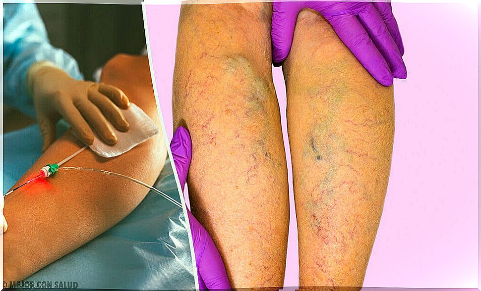 5 alternatives to treating varicose veins