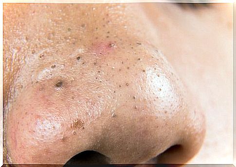 5 home remedies to fight blackheads