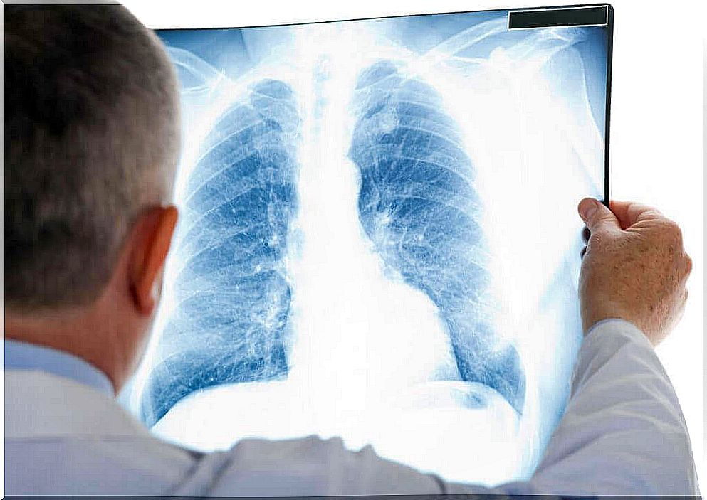 Diagnosis of atelectasis