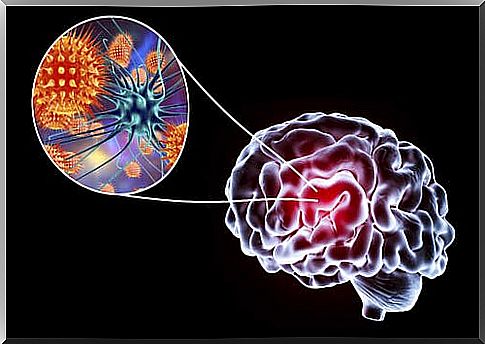 Encephalitis: symptoms, causes, and treatment