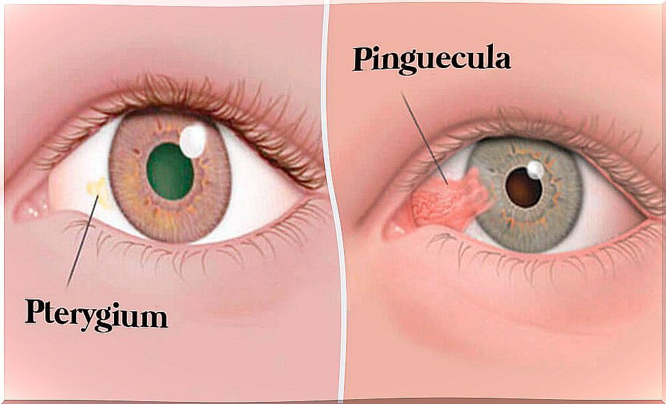 Eye tumors: pinguecula and pterygium