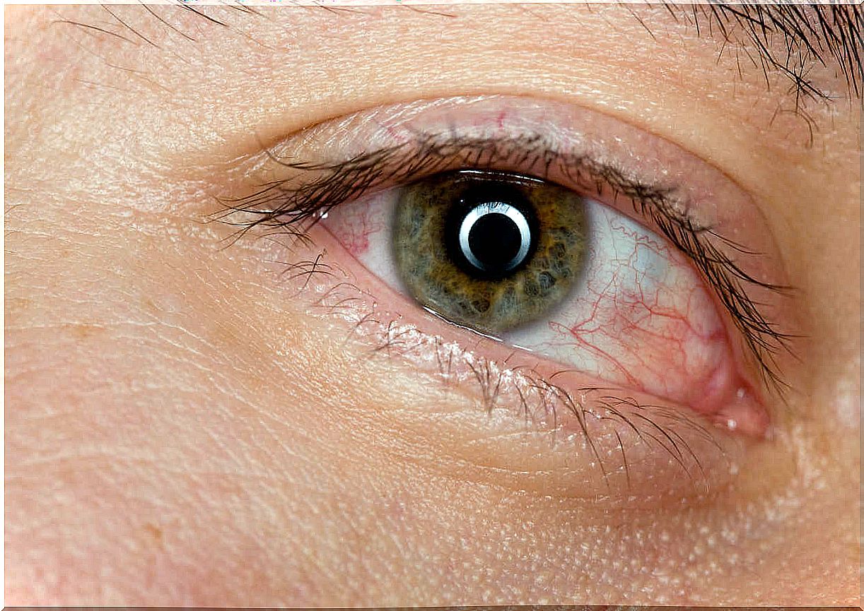 red eyes are signs of an eye tumor