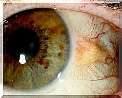 Eye tumors: pinguecula