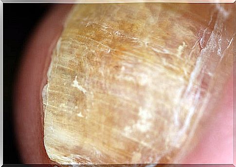 Fingernails with nail fungus 