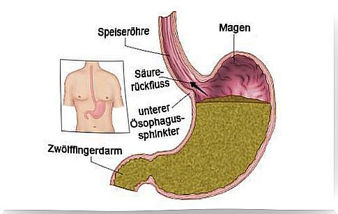 Heartburn - Treatment Options