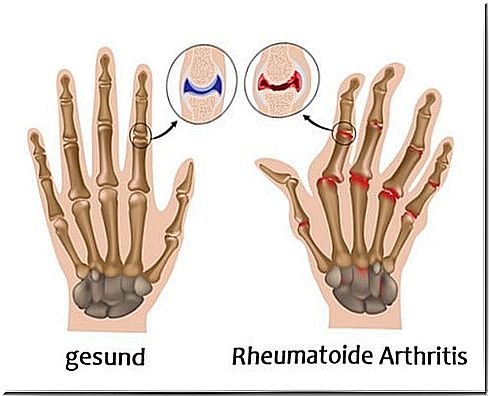 Arthritis hand