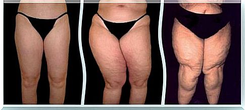 Lipedema: causes and treatment options