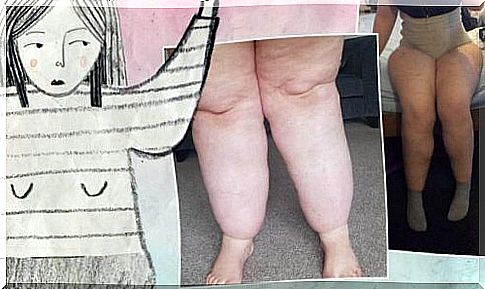 Woman with lipedema