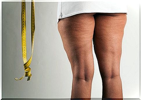 Woman with lipedema on her legs