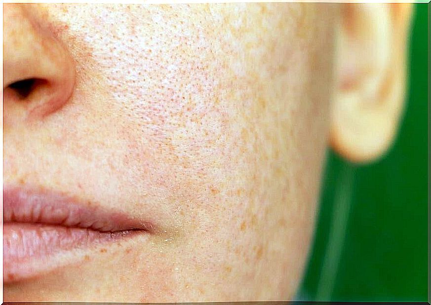 Melasma: 3 home remedies for pigment spots