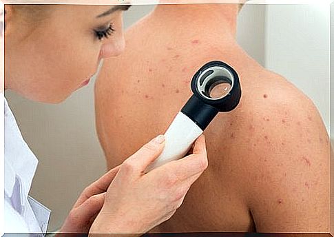 Natural healing methods for pimples on the upper body