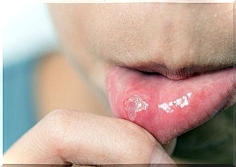 Fast treatment of aphthous ulcers