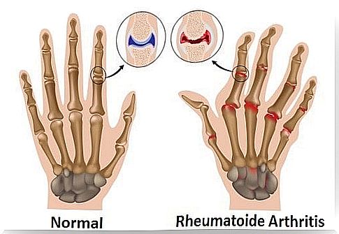 Alleviate arthritis naturally