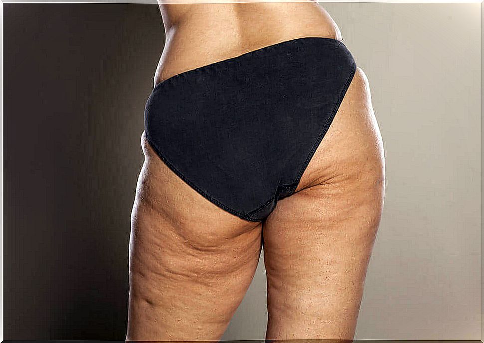 Home remedies for cellulite removal