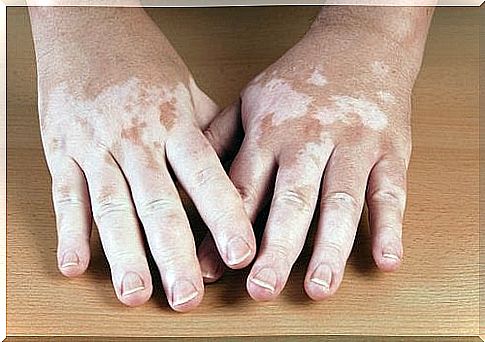 Skin care tips for vitiligo