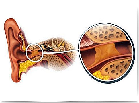 Illustration of a clogged ear canal