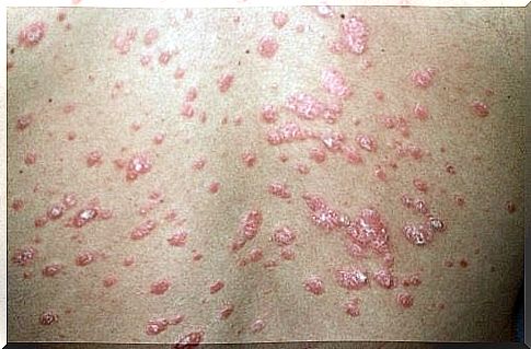 Types of psoriasis