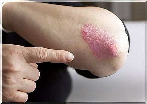 Psoriasis on the elbow