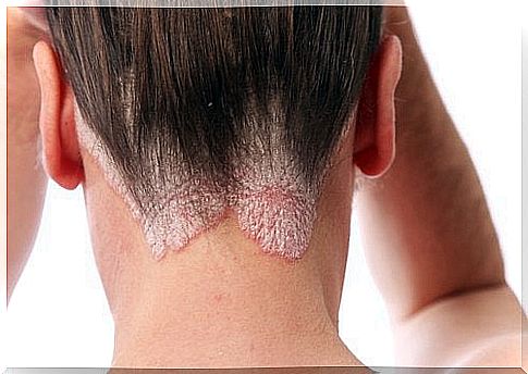 Psoriasis on the head