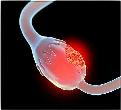 What is giant mucinous cystadenoma?